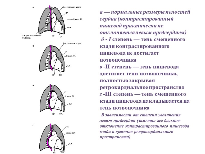 а — нормальные размеры полостей сердца (контрастированный пищевод практически не отклоняется левым предсердием) 